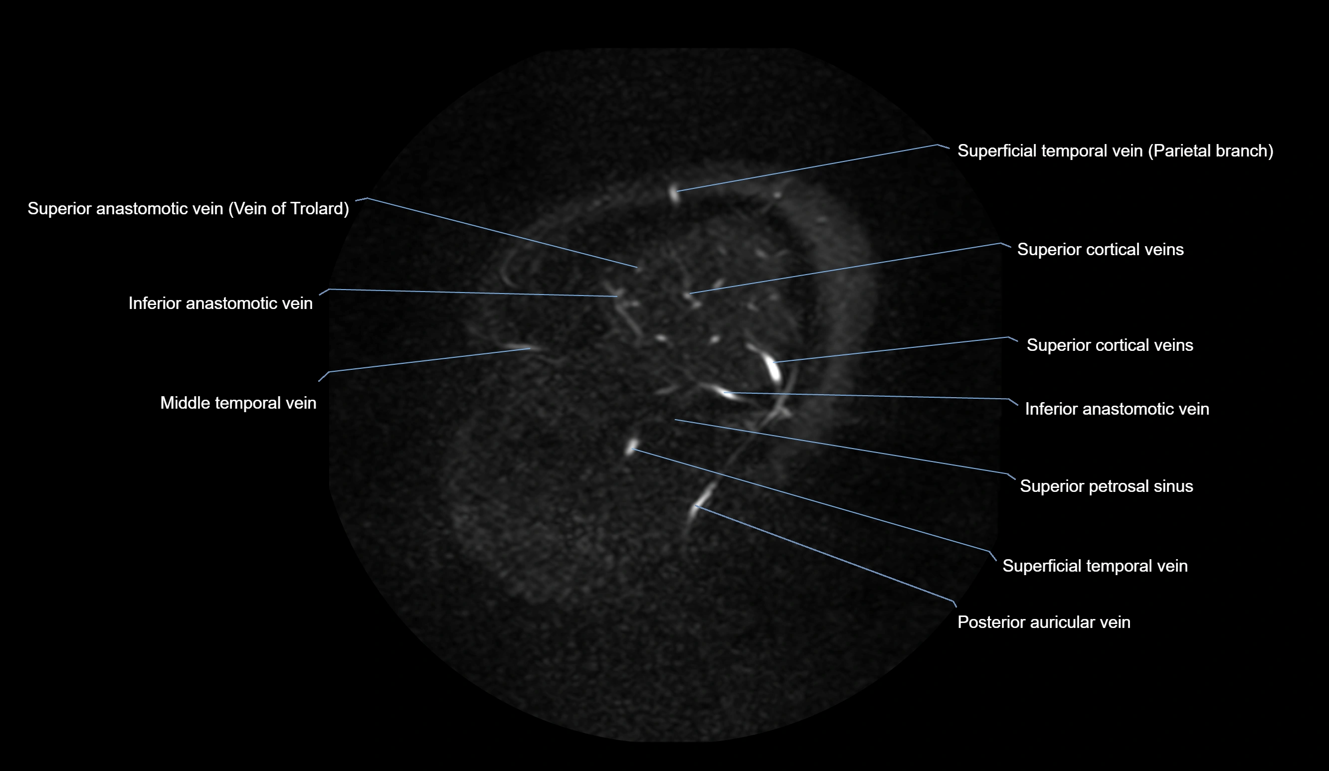 MRV brain sagittal anatomy 3T MRI images -img-01015-00013.webp